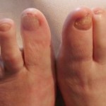 Ein durch Dematophyten verursachter Nagelpilz (c) nagelwohl.de
